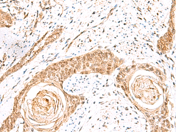 Immunohistochemistry of paraffin-embedded Human esophagus cancer tissue using TA366238 (ELF3 Antibody) at dilution 1/60 (Original magnification: x200)