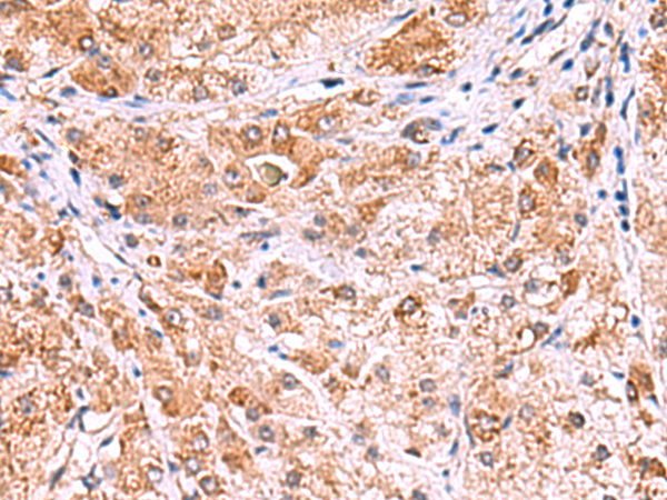 Immunohistochemistry of paraffin-embedded Human liver cancer tissue using TA366264 (UXS1 Antibody) at dilution 1/60 (Original magnification: x200)