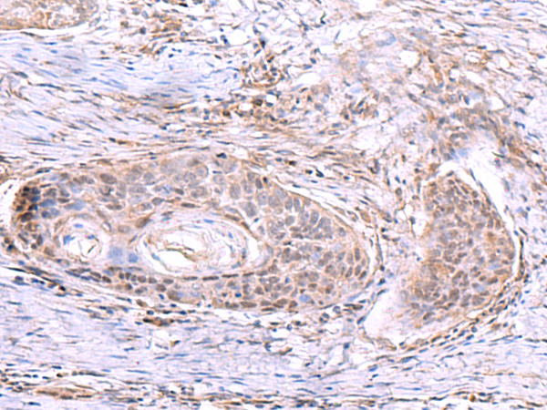 Immunohistochemistry of paraffin-embedded Human esophagus cancer tissue using TA366279 (AKAP17A Antibody) at dilution 1/80 (Original magnification: x200)