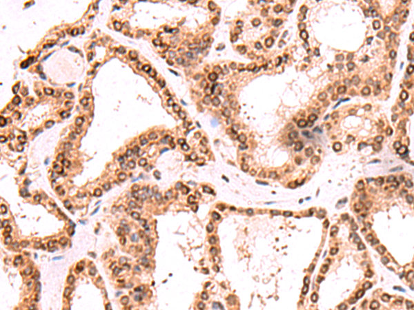 Immunohistochemistry of paraffin-embedded Human thyroid cancer tissue using TA366288 (TOR1AIP1 Antibody) at dilution 1/60 (Original magnification: x200)