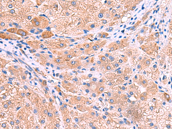 Immunohistochemistry of paraffin-embedded Human liver cancer tissue using TA366290 (MPP1 Antibody) at dilution 1/50 (Original magnification: x200)