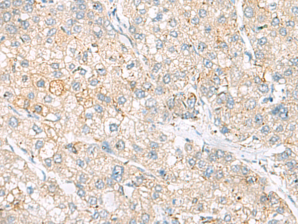 Immunohistochemistry of paraffin-embedded Human liver cancer tissue using TA366322 (FARP2 Antibody) at dilution 1/55 (Original magnification: x200)