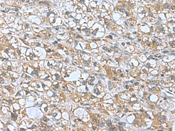 Immunohistochemistry of paraffin-embedded Human liver cancer tissue using TA366335 (KANSL1L Antibody) at dilution 1/55 (Original magnification: x200)