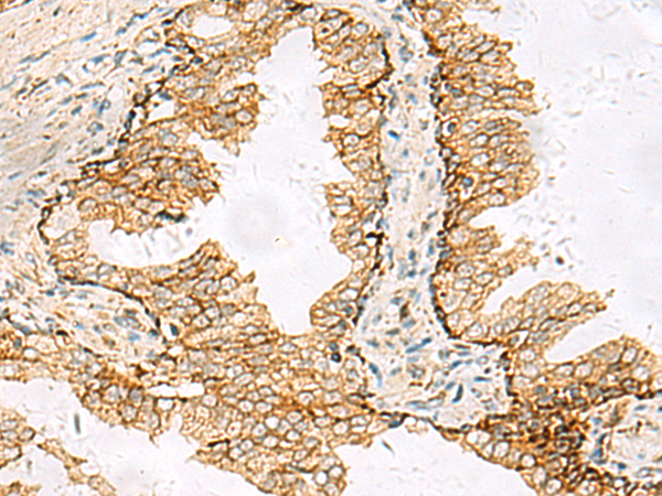 Immunohistochemistry of paraffin-embedded Human prostate cancer tissue using TA366345 (SH3YL1 Antibody) at dilution 1/55 (Original magnification: x200)