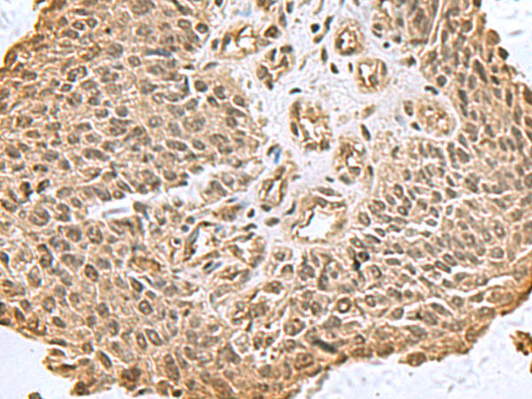 Immunohistochemistry of paraffin-embedded Human lung cancer tissue using TA366381 (DCTPP1 Antibody) at dilution 1/80 (Original magnification: x200)