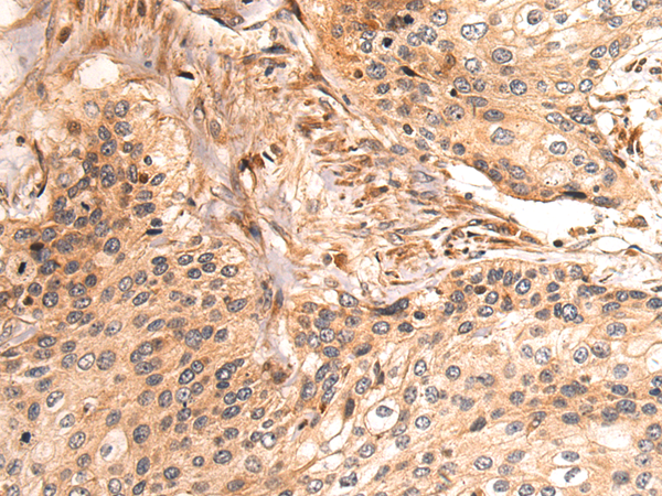 Immunohistochemistry of paraffin-embedded Human cervical cancer tissue using TA366388 (HYI Antibody) at dilution 1/50 (Original magnification: x200)