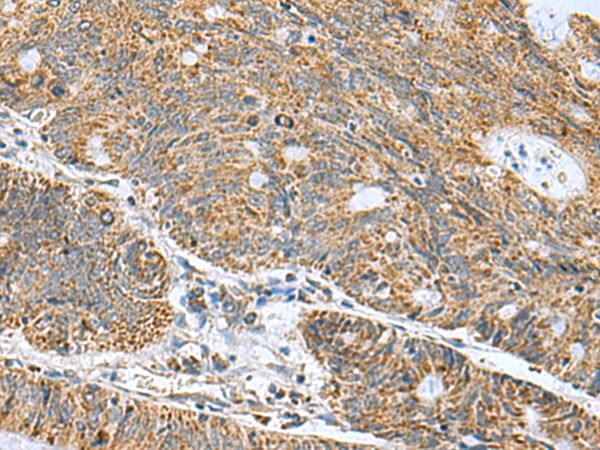 Immunohistochemistry of paraffin-embedded Human colorectal cancer tissue using TA366417 (MRPL40 Antibody) at dilution 1/50 (Original magnification: x200)