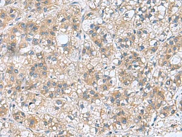 Immunohistochemistry of paraffin-embedded Human liver cancer tissue using TA366429 (RAB39A Antibody) at dilution 1/70 (Original magnification: x200)