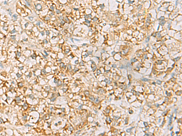 Immunohistochemistry of paraffin-embedded Human liver cancer tissue using TA366436 (HLA-DQB2 Antibody) at dilution 1/70 (Original magnification: x200)