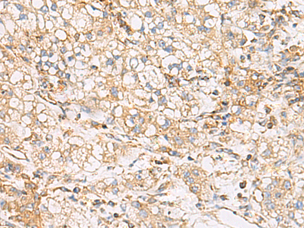 Detection of cytokeratin on paraffin-embedded sections of guinea pig breast carcinoma using anti-cytokeratin antibody (C-11).