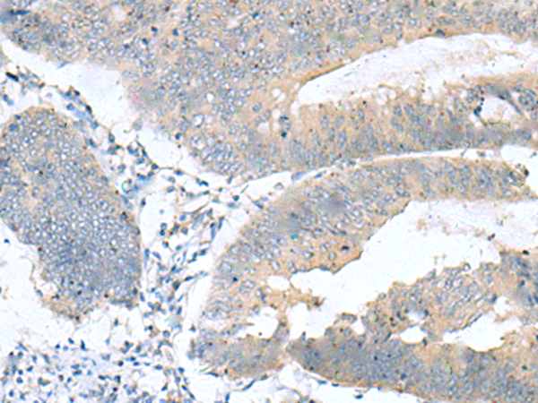 Immunohistochemistry of paraffin-embedded Human colorectal cancer tissue using TA366462 (KRCC1 Antibody) at dilution 1/60 (Original magnification: x200)