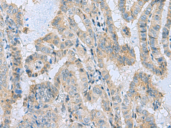 Immunohistochemistry of paraffin-embedded Human thyroid cancer tissue using TA366500 (MGME1 Antibody) at dilution 1/50 (Original magnification: x200)
