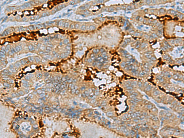 Immunohistochemistry of paraffin-embedded Human thyroid cancer tissue using TA366505 (ENKD1 Antibody) at dilution 1/75 (Original magnification: x200)