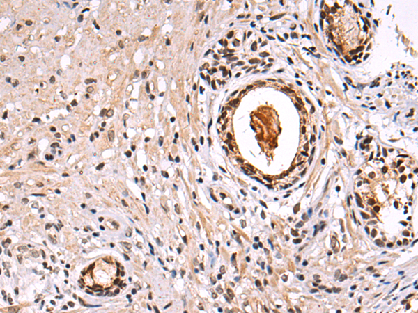 Immunohistochemistry of paraffin-embedded Human prostate cancer tissue using TA366509 (HEATR1 Antibody) at dilution 1/80 (Original magnification: x200)