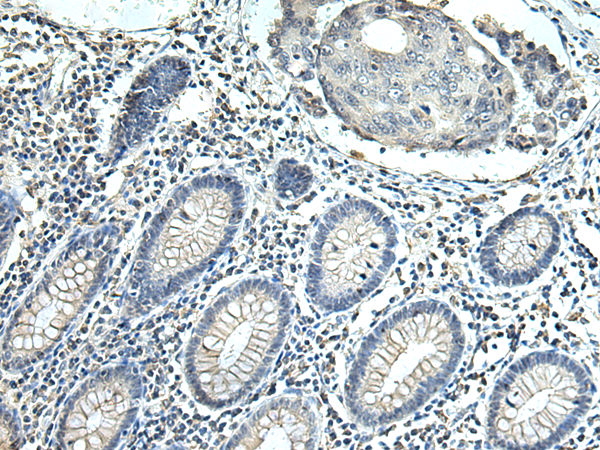 Immunohistochemistry of paraffin-embedded Human colorectal cancer tissue using TA366526 (SLC35F6 Antibody) at dilution 1/115 (Original magnification: x200)