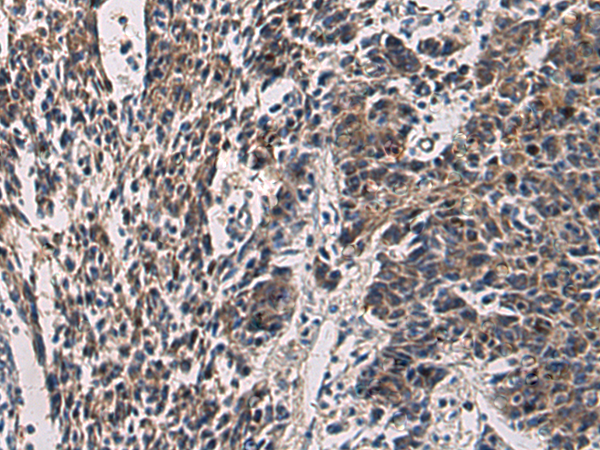 Immunohistochemistry of paraffin-embedded Human colorectal cancer tissue using TA366529 (CCNI Antibody) at dilution 1/60 (Original magnification: x200)