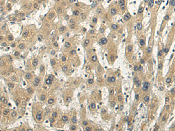 Immunohistochemistry of paraffin-embedded Human liver cancer tissue using TA366547 (STOML1 Antibody) at dilution 1/200 (Original magnification: x200)