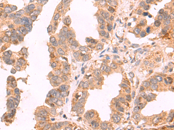 Immunohistochemistry of paraffin-embedded Human colorectal cancer tissue using TA366561 (GDPD2 Antibody) at dilution 1/55 (Original magnification: x200)