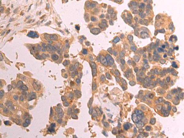 Immunohistochemistry of paraffin-embedded Human colorectal cancer tissue using TA366565 (COLGALT2 Antibody) at dilution 1/75 (Original magnification: x200)