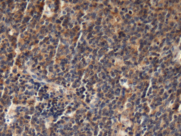 Immunohistochemistry of paraffin-embedded Human thyroid cancer tissue using TA366575 (EML1 Antibody) at dilution 1/75 (Original magnification: x200)