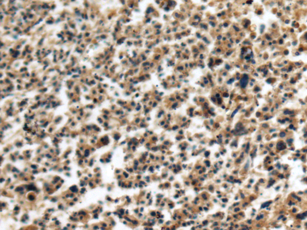 Immunohistochemistry of paraffin-embedded Human ovarian cancer tissue using TA366583 (FIBIN Antibody) at dilution 1/140 (Original magnification: x200)