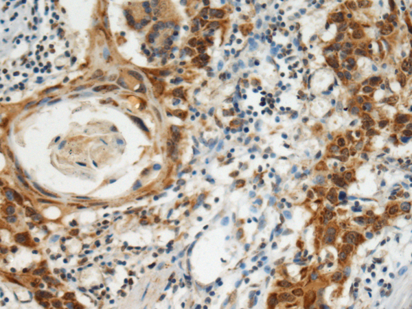 Immunohistochemistry of paraffin-embedded Human esophagus cancer tissue using TA366594 (CMC1 Antibody) at dilution 1/120 (Original magnification: x200)