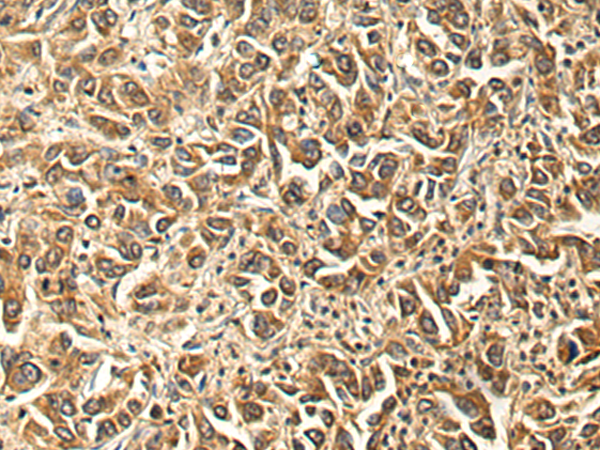 Immunohistochemistry of paraffin-embedded Human liver cancer tissue using TA366597 (FRMD5 Antibody) at dilution 1/190 (Original magnification: x200)