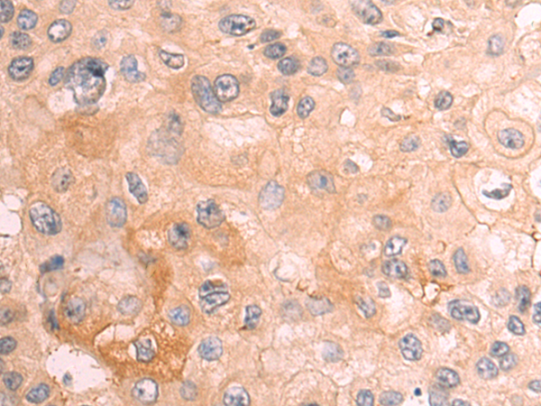 Immunohistochemistry of paraffin-embedded Human esophagus cancer tissue using TA366615 (RILPL1 Antibody) at dilution 1/70 (Original magnification: x200)