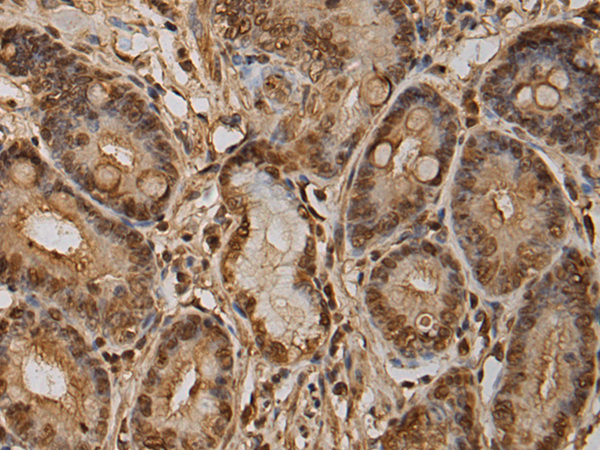 Immunohistochemistry of paraffin-embedded Human gastric cancer tissue using TA366623 (LBH Antibody) at dilution 1/210 (Original magnification: x200)