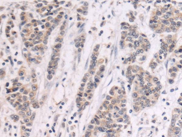 Immunohistochemistry of paraffin-embedded Human colorectal cancer tissue using TA366629 (GALNT3 Antibody) at dilution 1/105 (Original magnification: x200)