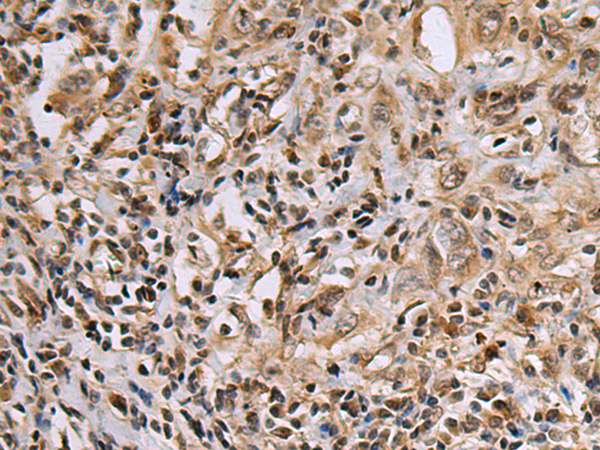 Immunohistochemistry of paraffin-embedded Human esophagus cancer tissue using TA366632 (DNA2 Antibody) at dilution 1/60 (Original magnification: x200)