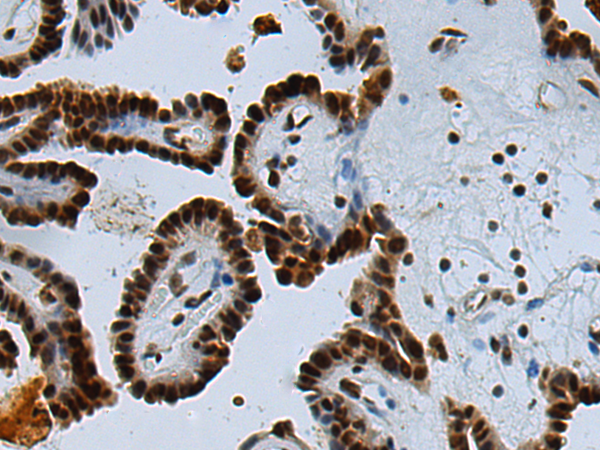 Immunohistochemistry of paraffin-embedded Human thyroid cancer tissue using TA366649 (UBE2O Antibody) at dilution 1/90 (Original magnification: x200)