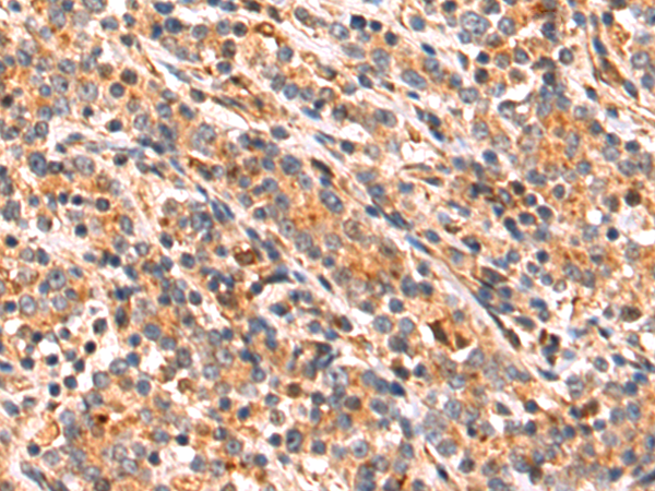 Immunohistochemistry of paraffin-embedded Human gastric cancer tissue using TA366661 (OSGIN2 Antibody) at dilution 1/70 (Original magnification: x200)
