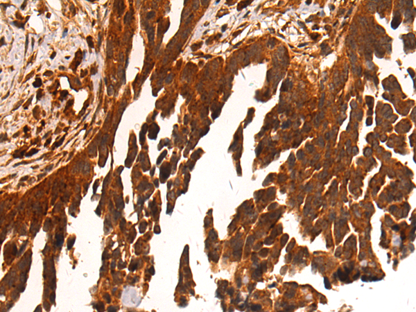 Immunohistochemistry of paraffin-embedded Human colorectal cancer tissue using TA366686 (TSR1 Antibody) at dilution 1/50 (Original magnification: x200)