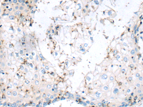 Immunohistochemistry of paraffin-embedded Human esophagus cancer tissue using TA366717 (PPFIA1 Antibody) at dilution 1/110 (Original magnification: x200)
