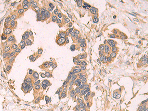 Immunohistochemistry of paraffin-embedded Human colorectal cancer tissue using TA366728 (SIMC1 Antibody) at dilution 1/80 (Original magnification: x200)