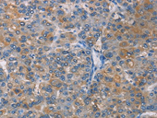 Immunohistochemistry of paraffin-embedded Human liver cancer tissue using TA366754 (ZBTB1 Antibody) at dilution 1/50 (Original magnification: x200)