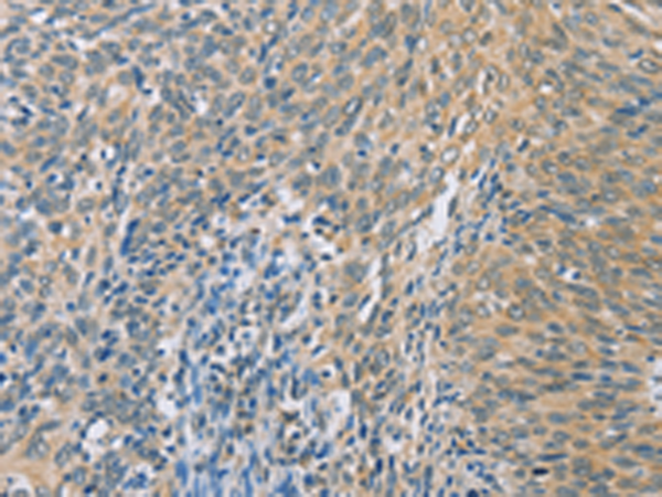Immunohistochemistry of paraffin-embedded Human cervical cancer tissue using TA366776 (ZHX3 Antibody) at dilution 1/100 (Original magnification: x200)