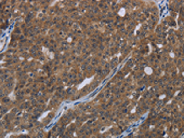 Immunohistochemistry of paraffin-embedded Human ovarian cancer tissue using TA366813 (HOXC8 Antibody) at dilution 1/20 (Original magnification: x200)