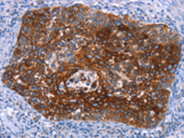 Immunohistochemistry of paraffin-embedded Human cervical cancer tissue using TA366845 (MAP3K2 Antibody) at dilution 1/15 (Original magnification: x200)