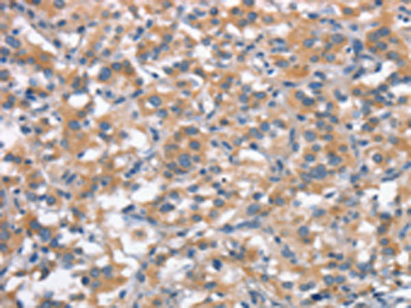 Immunohistochemistry of paraffin-embedded Human thyroid cancer tissue using TA366851 (ANP32C Antibody) at dilution 1/30 (Original magnification: x200)