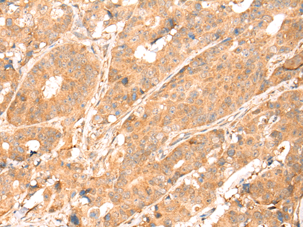 Immunohistochemistry of paraffin-embedded Human colorectal cancer tissue using TA366881 (ABCA10 Antibody) at dilution 1/25 (Original magnification: x200)