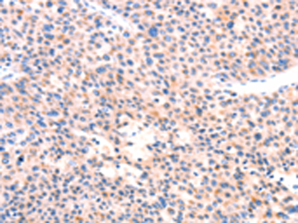 Immunohistochemistry of paraffin-embedded Human liver cancer tissue using TA366897 (APBA2 Antibody) at dilution 1/80 (Original magnification: x200)
