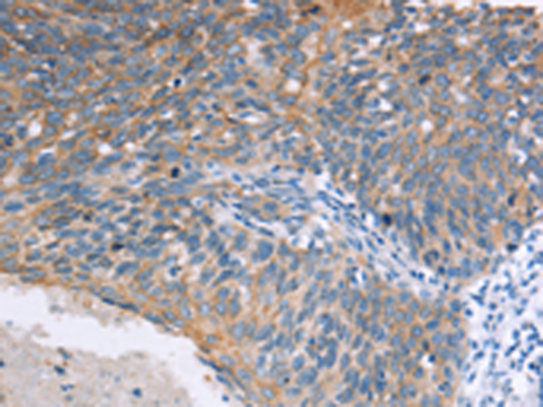 Immunohistochemistry of paraffin-embedded Human cervical cancer tissue using TA366940 (ELP3 Antibody) at dilution 1/15 (Original magnification: x200)
