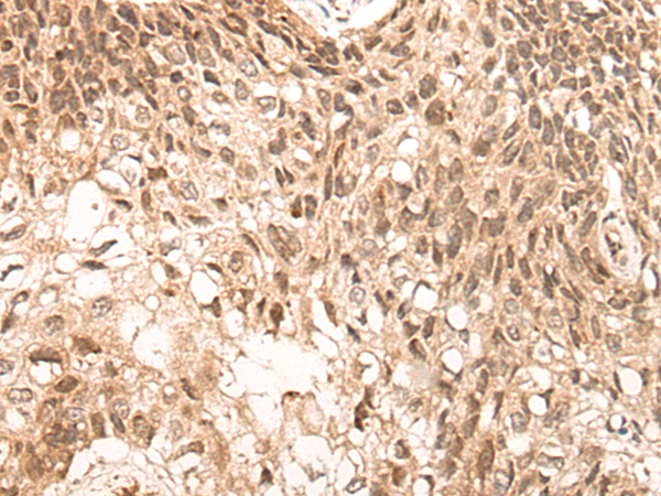 Immunohistochemistry of paraffin-embedded Human lung cancer tissue using TA366950 (NCOA6 Antibody) at dilution 1/30 (Original magnification: x200)