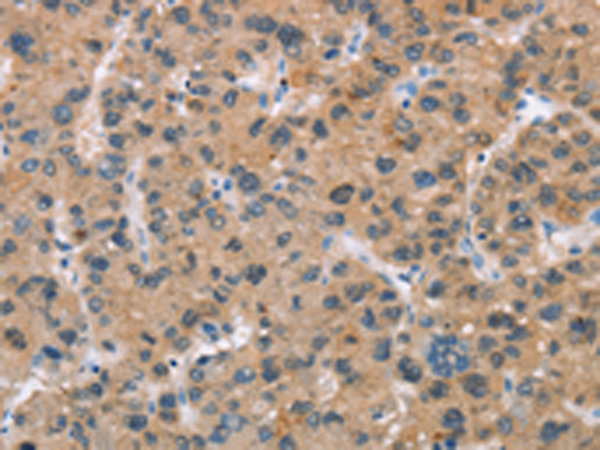 Immunohistochemistry of paraffin-embedded Human liver cancer tissue using TA366978 (ADGRB2 Antibody) at dilution 1/25 (Original magnification: x200)