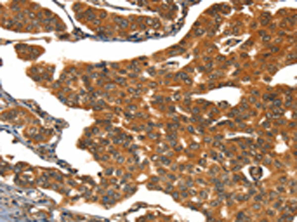 Immunohistochemistry of paraffin-embedded Human breast cancer tissue using TA366990 (CACNA1E Antibody) at dilution 1/15 (Original magnification: x200)