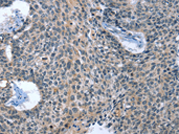 Immunohistochemistry of paraffin-embedded Human lung cancer tissue using TA366991 (CAGE1 Antibody) at dilution 1/15 (Original magnification: x200)