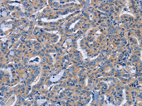Immunohistochemistry of paraffin-embedded Human thyroid cancer tissue using TA366998 (NCR2 Antibody) at dilution 1/60 (Original magnification: x200)