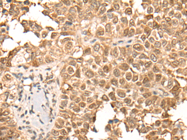 Immunohistochemistry of paraffin-embedded Human ovarian cancer tissue using TA367008 (CDCA5 Antibody) at dilution 1/25 (Original magnification: x200)